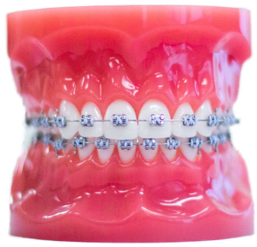 metal braces on model